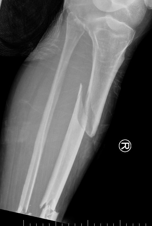 Segmental tibia 1